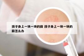 孩子身上一块一块的藓 孩子身上一块一块的藓怎么办