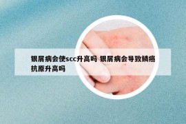 银屑病会使scc升高吗 银屑病会导致鳞癌抗原升高吗