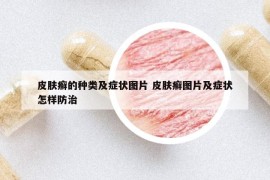 皮肤癣的种类及症状图片 皮肤癣图片及症状怎样防治