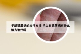 手部银屑病的治疗方法 手上有银屑病有什么偏方治疗吗