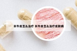 长牛皮怎么治疗 长牛皮怎么治疗皮肤病