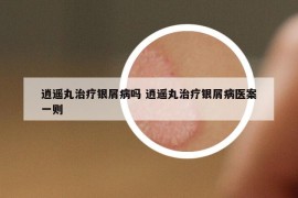 逍遥丸治疗银屑病吗 逍遥丸治疗银屑病医案一则