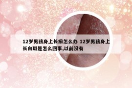 12岁男孩身上长癣怎么办 12岁男孩身上长白斑是怎么回事,以前没有