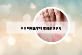 银屑病用坐牢吗 银屑病没事吧