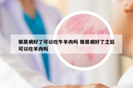 银屑病好了可以吃牛羊肉吗 银屑病好了之后可以吃羊肉吗