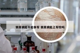 银屑病能不能参军 银屑病能上军校吗