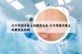 六个月孩子身上长癣怎么办 六个月孩子身上长癣怎么办啊