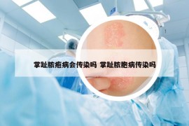 掌趾脓疱病会传染吗 掌趾脓胞病传染吗