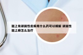 腿上有顽固性皮癣用什么药可以缓解 顽固性腿上癣怎么治疗