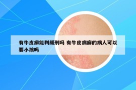 有牛皮癣能判缓刑吗 有牛皮病癣的病人可以要小孩吗