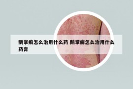 鹅掌癣怎么治用什么药 鹅掌癣怎么治用什么药膏