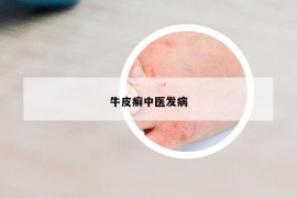 牛皮癣中医发病