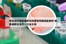 听说治疗银屑病照光效果如何随到能做吗 银屑病照光治疗一次多少钱