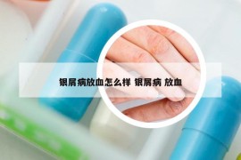 银屑病放血怎么样 银屑病 放血