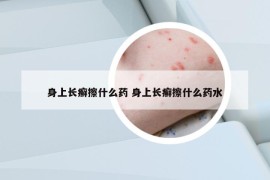 身上长癣擦什么药 身上长癣擦什么药水