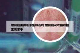 银屑病用得着采集血液吗 银屑病可以抽血检查出来不