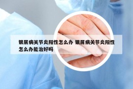 银屑病关节炎阳性怎么办 银屑病关节炎阳性怎么办能治好吗