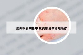 反向银屑病指甲 反向银屑病更难治疗