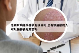 患银屑病能接种新冠疫苗吗 患有银屑病的人可以接种新冠疫苗吗