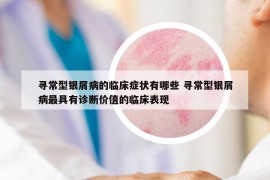 寻常型银屑病的临床症状有哪些 寻常型银屑病最具有诊断价值的临床表现