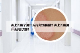 身上长癣了用什么药膏效果最好 身上长癣用什么药比较好