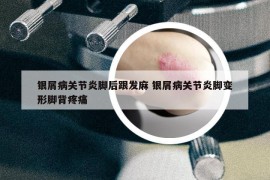 银屑病关节炎脚后跟发麻 银屑病关节炎脚变形脚背疼痛