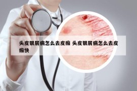 头皮银屑病怎么去皮痂 头皮银屑病怎么去皮痂快