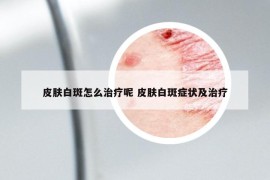 皮肤白斑怎么治疗呢 皮肤白斑症状及治疗