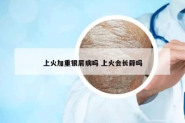 上火加重银屑病吗 上火会长藓吗