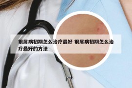 银屑病初期怎么治疗最好 银屑病初期怎么治疗最好的方法