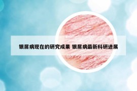 银屑病现在的研究成果 银屑病最新科研进展