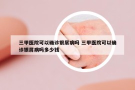 三甲医院可以确诊银屑病吗 三甲医院可以确诊银屑病吗多少钱