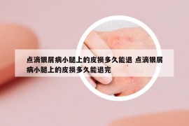 点滴银屑病小腿上的皮损多久能退 点滴银屑病小腿上的皮损多久能退完