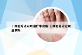 干细胞疗法可以治疗牛皮癣 干细胞能治愈银屑病吗