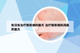 有没有治疗银屑病的偏方 治疗银屑病民间最灵偏方