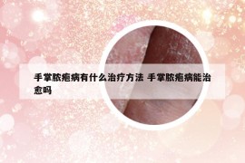 手掌脓疱病有什么治疗方法 手掌脓疱病能治愈吗