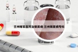 兰州哪家医院治银屑病 兰州银屑病专科