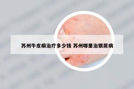 苏州牛皮癣治疗多少钱 苏州哪里治银屑病