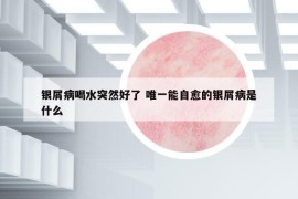 银屑病喝水突然好了 唯一能自愈的银屑病是什么