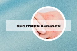 发际线上的银屑病 发际线有头皮癣