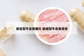 脓包型牛皮屑图片 脓疱型牛皮屑症状