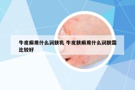 牛皮癣用什么润肤乳 牛皮肤癣用什么润肤霜比较好