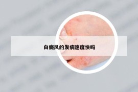 白癜风的发病速度快吗