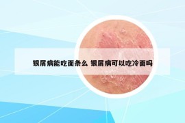 银屑病能吃面条么 银屑病可以吃冷面吗