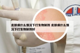 皮肤病什么情况下打生物制剂 皮肤病什么情况下打生物制剂好