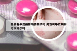 男的有牛皮癣影响要孩子吗 男性有牛皮病癣可以怀孕吗