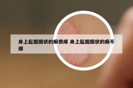 身上起圆圈状的癣很痒 身上起圆圈状的癣不痒