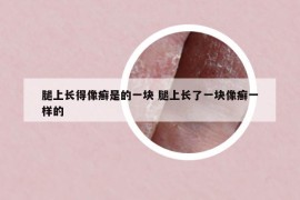 腿上长得像癣是的一块 腿上长了一块像癣一样的