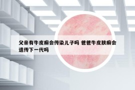 父亲有牛皮癣会传染儿子吗 爸爸牛皮肤癣会遗传下一代吗