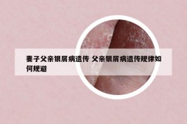 妻子父亲银屑病遗传 父亲银屑病遗传规律如何规避